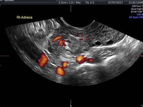 ovarian torsion cause positive pregnancy test|ovarian torsion ultrasound results.